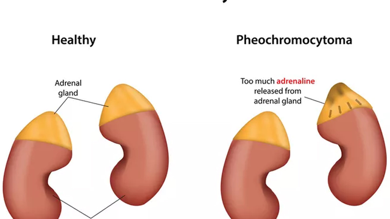 Kanker Kelenjar Adrenal: Tanda-tanda dan Pencegahan dari PAFI Pacitan